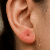 allergic reactions on ear